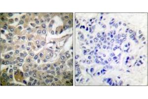 Immunohistochemistry analysis of paraffin-embedded human breast carcinoma tissue, using Rac1/CDC42 (Ab-71) Antibody. (RAC1+CDC42 (AA 38-87) Antikörper)