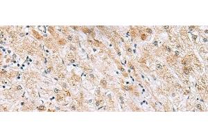 Immunohistochemistry of paraffin-embedded Human liver cancer tissue using GPC2 Polyclonal Antibody at dilution of 1:40(x200) (GPC2 Antikörper)