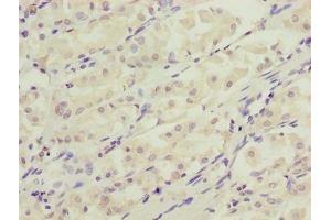 Immunohistochemistry of paraffin-embedded human gastric cancer using ABIN7150132 at dilution of 1:100
