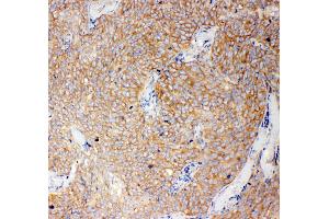 Anti-Caspase-12 antibody, IHC(P) IHC(P): Human Lung Cancer Tissue (Caspase 12 Antikörper  (N-Term))