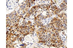 Immunohistochemistry analysis of paraffin-embedded human lung cancer using CD107b Polyclonal Antibody at dilution of 1:300. (LAMP2 Antikörper)