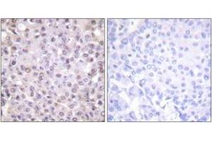 Immunohistochemistry analysis of paraffin-embedded human breast carcinoma tissue, using NCoR1 Antibody. (NCOR1 Antikörper  (AA 51-100))