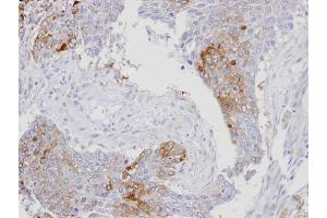 IHC-P Image Immunohistochemical analysis of paraffin-embedded human lung SCC, using RanBP16, antibody at 1:100 dilution. (Exportin 7 Antikörper  (C-Term))