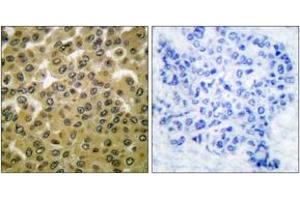 Immunohistochemistry analysis of paraffin-embedded human breast carcinoma, using GSK3 alpha/beta (Phospho-Tyr279/216) Antibody. (GSK3 alpha/beta Antikörper  (pTyr279))