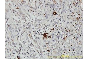 Immunoperoxidase of monoclonal antibody to ORM1 on formalin-fixed paraffin-embedded human stomach carcinoma tissue. (ORM1 Antikörper  (AA 18-201))