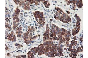 Immunohistochemical staining of paraffin-embedded Carcinoma of Human lung tissue using anti-FDFT1 mouse monoclonal antibody. (FDFT1 Antikörper)