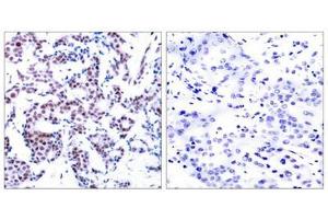 Immunohistochemical analysis of paraffin-embedded human breast carcinoma tissue using JunB(Phospho-Ser259) Antibody(left) or the same antibody preincubated with blocking peptide(right). (JunB Antikörper  (pSer259))