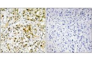 Immunohistochemistry analysis of paraffin-embedded human liver carcinoma tissue, using LEG4 Antibody. (GAL4 Antikörper  (AA 61-110))