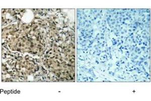 Imunohistochemical analysis of paraffin-embedded human breast carcinoma tissue using G3BP1 polyclonal antibody . (G3BP1 Antikörper)