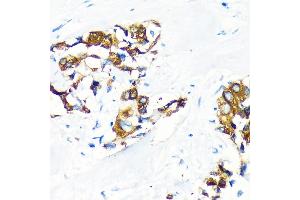 Immunohistochemistry of paraffin-embedded Human lung cancer using  Rabbit pAb (ABIN6131176, ABIN6136646, ABIN6136647 and ABIN6222857) at dilution of 1:100 (40x lens). (AGR2 Antikörper  (AA 21-175))