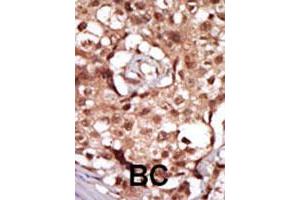 Formalin-fixed and paraffin-embedded human cancer tissue reacted with RIPK2 polyclonal antibody  , which was peroxidase-conjugated to the secondary antibody, followed by AEC staining. (RIPK2 Antikörper  (C-Term))