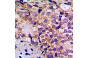 Immunohistochemical analysis of BIM (pS69) staining in human breast cancer formalin fixed paraffin embedded tissue section. (BIM Antikörper  (pSer69))