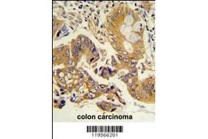 Formalin-fixed and paraffin-embedded human colon carcinoma reacted with CLNS1A Antibody , which was peroxidase-conjugated to the secondary antibody, followed by DAB staining. (CLNS1A Antikörper  (AA 148-176))