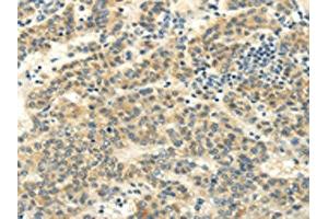 The image on the left is immunohistochemistry of paraffin-embedded Human liver cancer tissue using ABIN7130215(MED16 Antibody) at dilution 1/20, on the right is treated with fusion protein. (MED16 Antikörper)