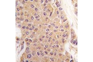 IHC analysis of FFPE human breast carcinoma tissue stained with TGF Beta 2 antibody (TGFB2 Antikörper  (AA 277-306))