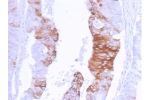 Formalin-fixed, paraffin-embedded human Colon Carcinoma stained with Cytokeratin 20 Recombinant Rabbit Monoclonal Antibody (KRT20/3129R). (Rekombinanter KRT20 Antikörper  (AA 196-323))