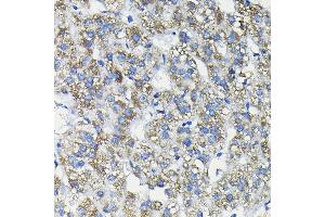 Immunohistochemistry of paraffin-embedded human liver cancer using FUC Rabbit pAb (ABIN6127916, ABIN6140809, ABIN6140811 and ABIN6215812) at dilution of 1:200 (40x lens). (FUCA2 Antikörper  (AA 118-467))
