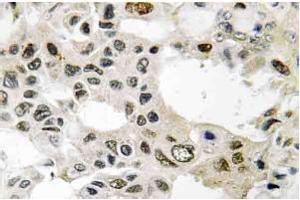 Immunohistochemistry (IHC) analyzes of eIF3D antibody staining in Paraffin-Embedded Human breast carcinoma tissue. (EIF3D Antikörper)