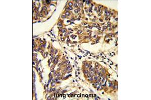 Formalin-fixed and paraffin-embedded human lung carcinoma reacted with PABPC1 Antibody , which was peroxidase-conjugated to the secondary antibody, followed by DAB staining. (PABP Antikörper  (AA 250-279))