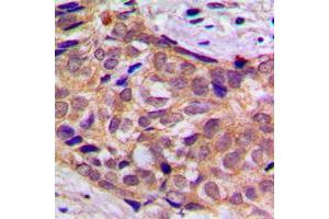 Immunohistochemical analysis of 14-3-3 theta staining in human prostate cancer formalin fixed paraffin embedded tissue section. (14-3-3 theta Antikörper  (Center))