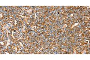 Immunohistochemistry of paraffin-embedded Human cervical cancer tissue using SLC8A3 Polyclonal Antibody at dilution 1:35 (SLC8A3 Antikörper)