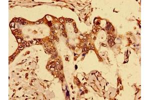 Immunohistochemistry of paraffin-embedded human breast cancer using ABIN7150562 at dilution of 1:100 (DOK1 Antikörper  (AA 1-481))