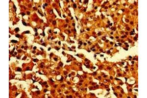 Immunohistochemistry of paraffin-embedded human breast cancer using ABIN7146907 at dilution of 1:100 (CARD14 Antikörper  (AA 249-523))