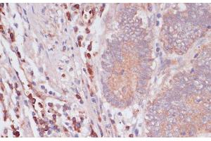 Immunohistochemistry of paraffin-embedded Human colon carcinoma using IFNAR2 Polyclonal Antibody at dilution of 1:100 (40x lens).