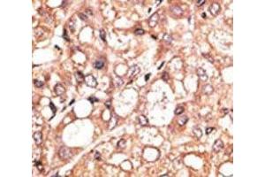 IHC analysis of FFPE human hepatocarcinoma stained with the LSD1 antibody (LSD1 Antikörper  (AA 457-490))