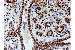 Immunohistochemical staining of paraffin-embedded Human breast tissue using anti-PADI4 mouse monoclonal antibody. (PAD4 Antikörper)