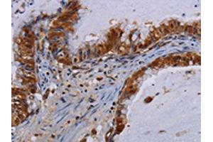 The image on the left is immunohistochemistry of paraffin-embedded Human esophagus cancer tissue using ABIN7130211(MECP2 Antibody) at dilution 1/60, on the right is treated with fusion protein. (MECP2 Antikörper)