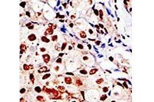 IHC analysis of FFPE human breast carcinoma tissue stained with the SUMO antibody (SUMO1 Antikörper  (AA 52-79))