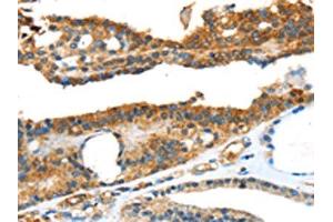 The image on the left is immunohistochemistry of paraffin-embedded Human thyroid cancer tissue using ABIN7131111(SNAI3 Antibody) at dilution 1/20, on the right is treated with fusion protein. (SNAI3 Antikörper)