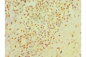 Immunohistochemistry of paraffin-embedded human breast cancer using ABIN7162034 at dilution of 1:100 (NXNL1 Antikörper  (AA 1-200))