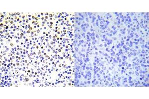 Immunohistochemical analysis of paraffin- embedded human malignant lymphoma tissue using Histone H3. (Histone H3.1 Antikörper)