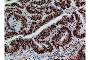 Immunohistochemistry (IHC) analysis of paraffin-embedded Human Colont-cancer, antibody was diluted at 1:200.