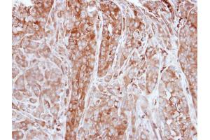 IHC-P Image Immunohistochemical analysis of paraffin-embedded A549 xenograft, using FTL, antibody at 1:500 dilution. (FTL Antikörper)