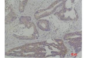 Immunohistochemistry (IHC) analysis of paraffin-embedded Human Breast Carcinoma using TBP Rabbit Polyclonal Antibody diluted at 1:200. (TBP Antikörper)