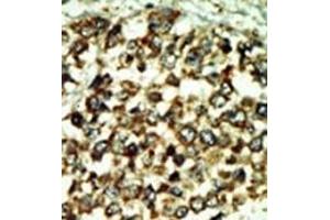 Formalin-fixed and paraffin-embedded human cancer tissue reacted with the primary antibody, which was peroxidase-conjugated to the secondary antibody, followed by DAB staining. (ATM Antikörper  (C-Term))