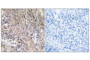 Immunohistochemistry analysis of paraffin-embedded human lung carcinoma tissue using LAMP3 antibody.