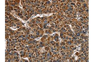 The image on the left is immunohistochemistry of paraffin-embedded Human liver cancer tissue using ABIN7128790(CAT Antibody) at dilution 1/40, on the right is treated with fusion protein.