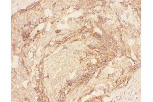 IHC-P: Eotaxin 3 antibody testing of human breast cancer tissue (CCL26 Antikörper  (AA 24-94))