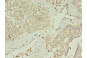 Immunohistochemistry of paraffin-embedded human endometrial cancer using ABIN7148088 at dilution of 1:100 (CCDC14 Antikörper  (AA 159-440))