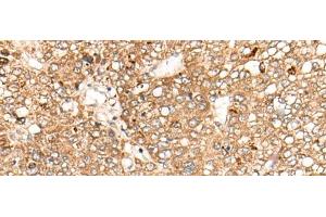 Immunohistochemistry of paraffin-embedded Human liver cancer tissue using C1S Polyclonal Antibody at dilution of 1:55(x200) (C1S Antikörper)