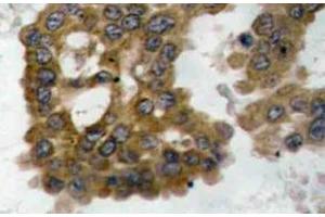 Immunohistochemistry (IHC) analyzes of p-Akt2 antibody in paraffin-embedded human lung carcinoma tissue. (AKT2 Antikörper  (pSer474))