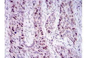 Immunohistochemical analysis of paraffin-embedded cervical cancer tissues using HDAC10 mouse mAb with DAB staining. (HDAC10 Antikörper  (AA 18-219))