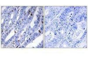 Immunohistochemistry analysis of paraffin-embedded human colon carcinoma tissue using PKA-R2β (Ab-113) antibody. (PRKAR2B Antikörper  (Ser113))