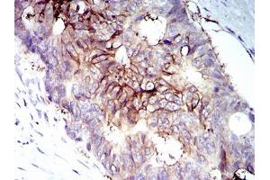 Immunohistochemical analysis of paraffin-embedded rectum cancer tissues using IGF1R-Beta mouse mAb with DAB staining.