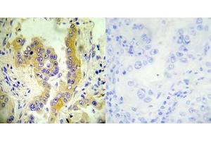 Immunohistochemical analysis of paraffin- embedded human lung carcinoma tissue using Tsc2 (Ab-1462) antibody (E022050). (Tuberin Antikörper)