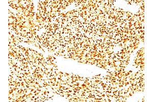 Formalin-fixed, paraffin-embedded human Rhabdomyosarcoma stained with MyoD1 Mouse Monoclonal Antibody (SPM427). (MYOD1 Antikörper  (AA 180-189))